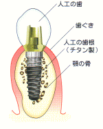 岐阜県 多治見市 インプラント